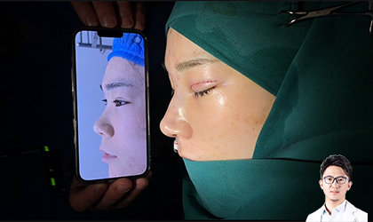 鼻修复案例前后对比