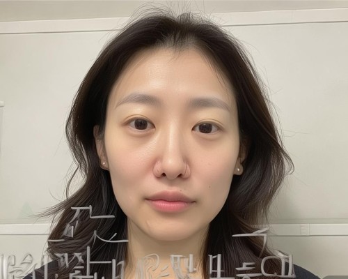 鼻翼过宽矫正，专业鼻整形医生带你了解手术细节与术后护理