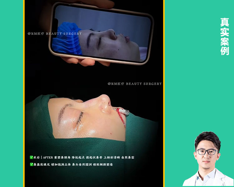 鼻修复案例前后对比