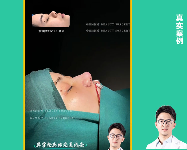 肋骨鼻综合即刻视频