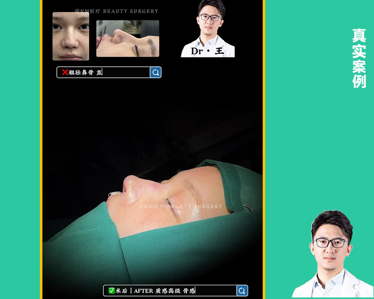 上海王旭东医生肋骨鼻综合即可案例